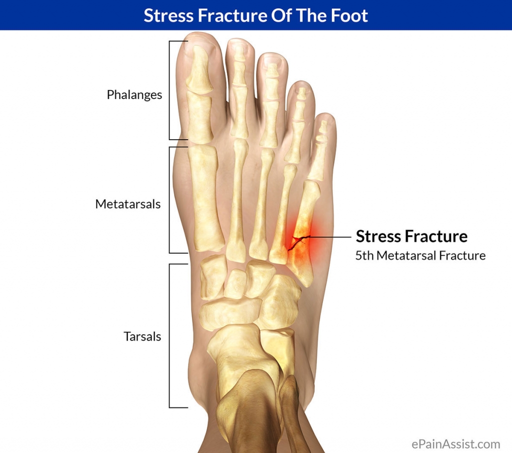 TIPS AND SUPPLEMENTS FOR HEALING BONE FRACTURES