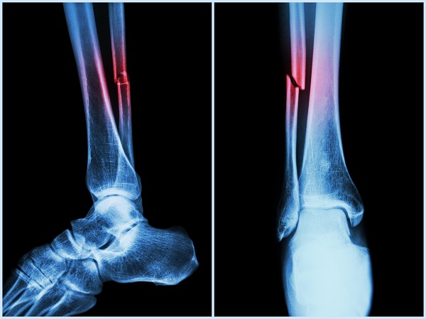 Xray of Fracture