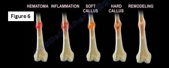 Image result for 5 stages of bone healing