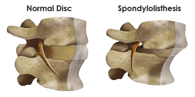 spondylolisthesis