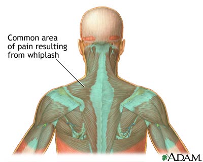 pain area for whiplash