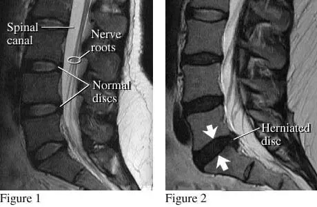 Image result for mri of back