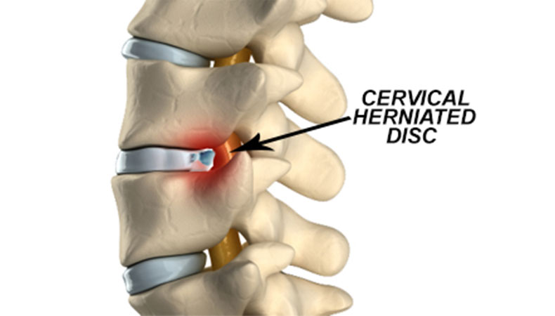 Image result for cervical vs lumbar herniation