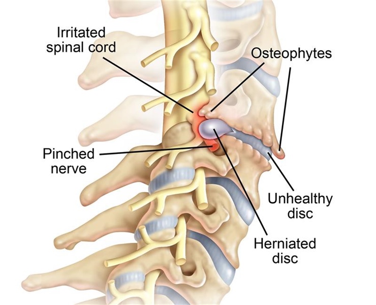 Image result for cervical vs lumbar herniation