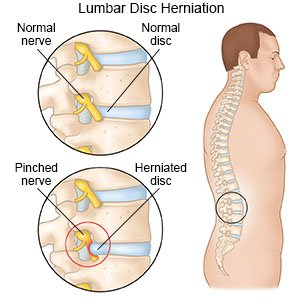 Image result for lumbar herniation