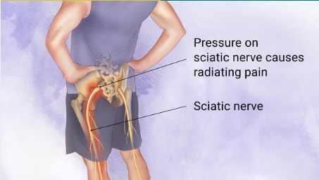 Image result for sciatica from herniated disc