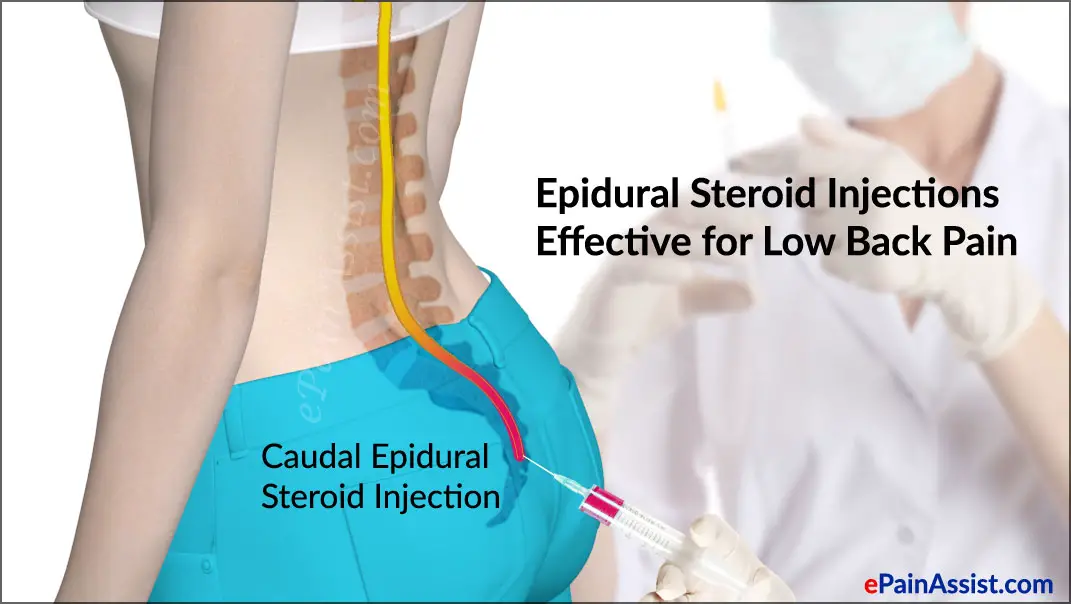 Image result for epidural steroid injection lumbar