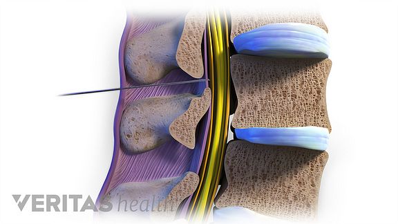 Image result for epidural steroid injection lumbar