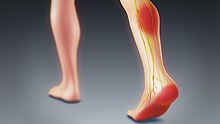 Image result for sciatica