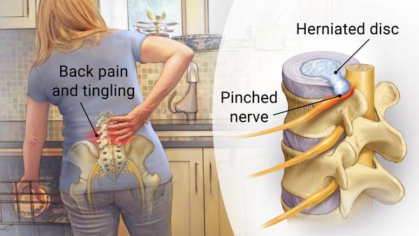 woman with sciatic pain