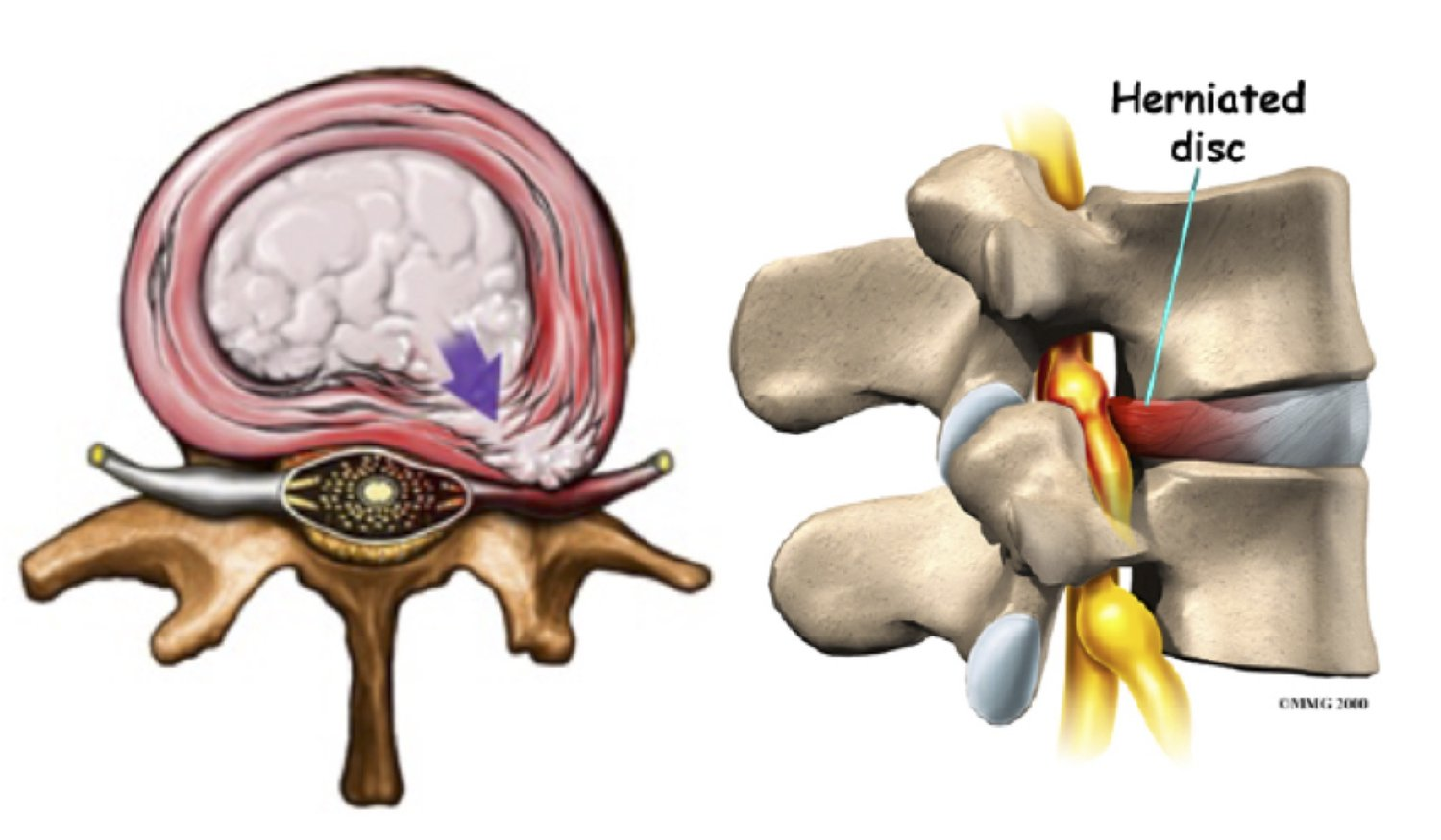 Image result for disc herniations