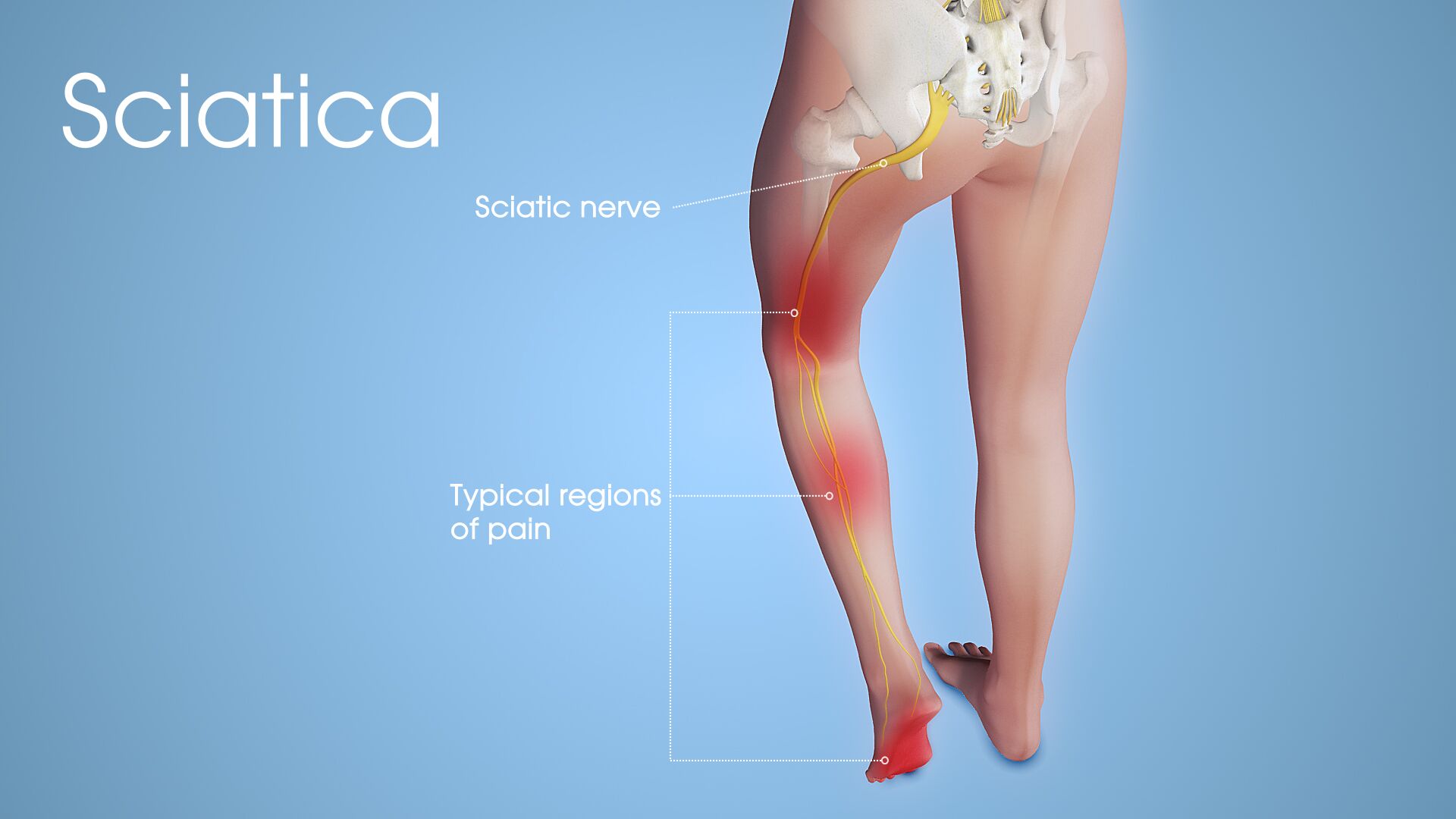 Image result for sciatica