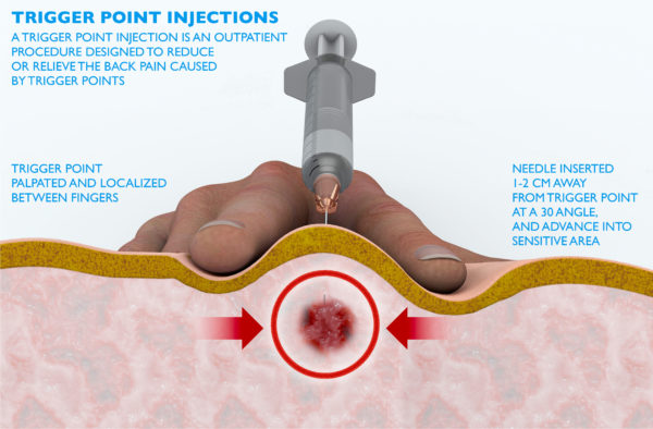 Image result for trigger point injections