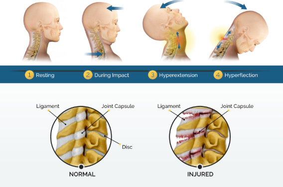 whiplash injury