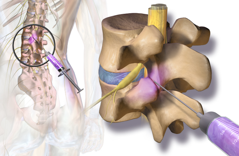 Image result for facet joint injection